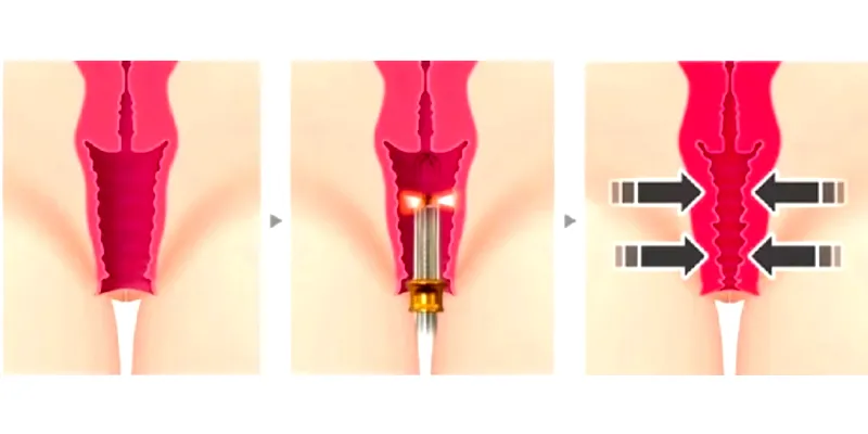 5 cách thu hẹp âm đạo giãn nở sau sinh và bảng giá mới nhất 2026 3 Thu hẹp có bé bằng laser