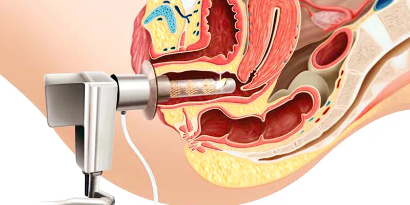 Trẻ Hóa Âm Đạo Cách Nào “Dịu Dàng” Hơn. Bảng Giá Và Ưu Nhược Điểm Các Phương Pháp Hiện Nay 2 trẻ hóa vùng kín bằng laser