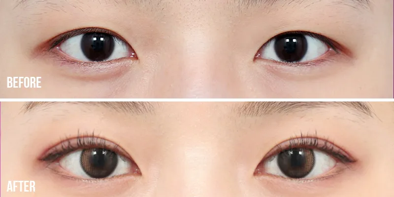 Nhấn mí vi điểm là gì? Ưu điểm và bảng giá mới nhất 2026 5 mat mi lot min