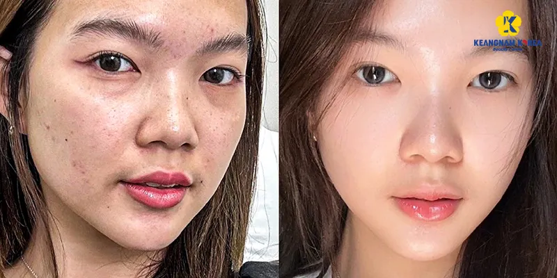 No-needle Mesotherapy Cost: How Much It Is and How Long Results Last 3 How Much Does No-needle Mesotherapy Cost in Vietnam