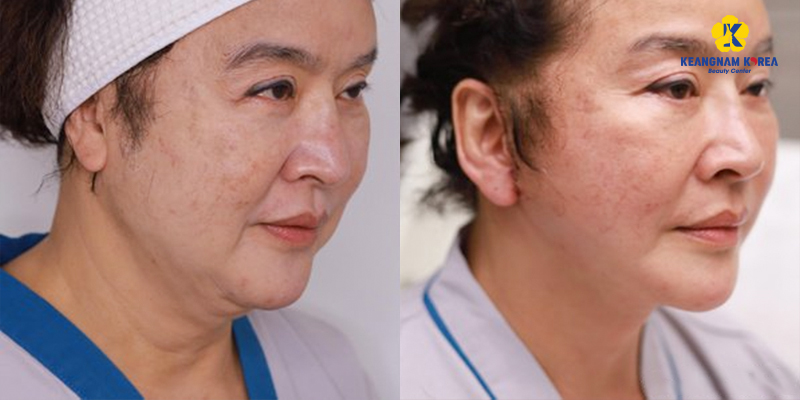 Is a Non-Surgical Neck Lift Worth It? Benefits, Methods & 2026 Cost Guide In Ho Chi Minh City 2 non surgical neck lift before and after