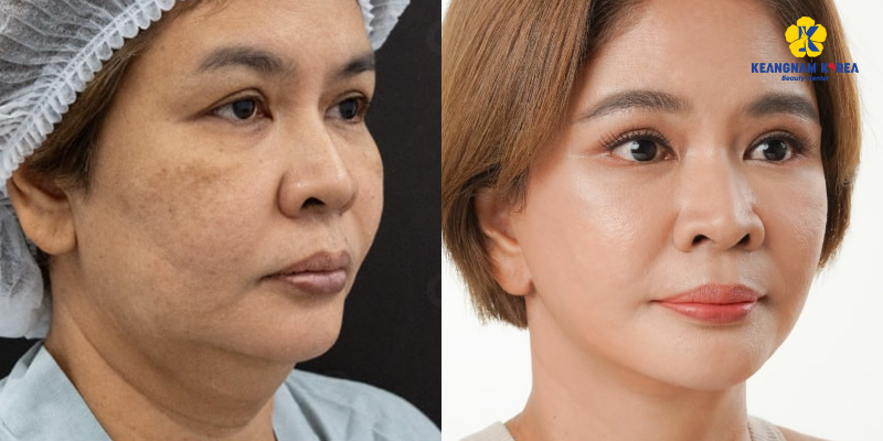 Is a Non-Surgical Neck Lift Worth It? Benefits, Methods & 2026 Cost Guide In Ho Chi Minh City 3 non-surgical neck lift before and after