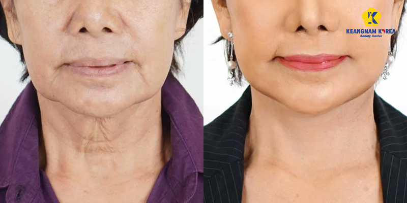 Is a Non-Surgical Neck Lift Worth It? Benefits, Methods & 2026 Cost Guide In Ho Chi Minh City 4 non-surgical neck tightening before and after