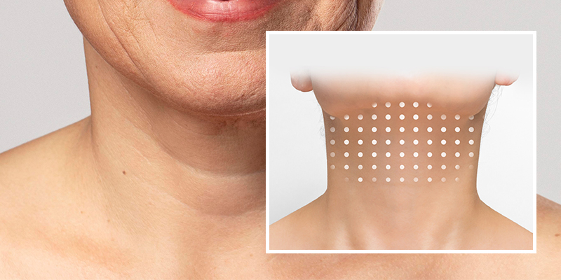 Is a Non-Surgical Neck Lift Worth It? Benefits, Methods & 2026 Cost Guide In Ho Chi Minh City 1 non-surgical neck lift
