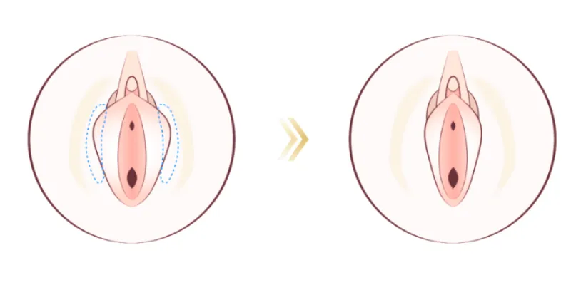 Có nên phẫu thuật thu hẹp vùng kín không? Ưu nhược điểm so với laser là gì? 2 phau thuat thu hep am dao 4