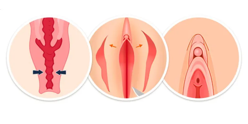 Có nên phẫu thuật thu hẹp vùng kín không? Ưu nhược điểm so với laser là gì? 4 phẫu thuật thu hẹp vùng kín