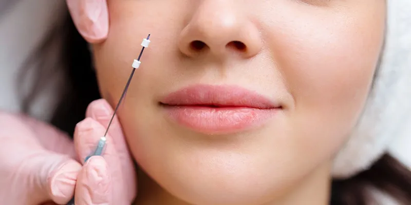 Cấy chỉ collagen làm đầy má hóp có hiệu quả không? Giữ được bao lâu? Ưu nhược điểm là gì? 5 Cấy chỉ collagen làm đầy má hóp