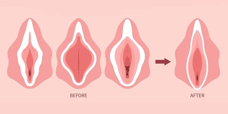 Thẩm Mỹ Vùng Kín: Cẩm Nang Tái Sinh "Đóa Hồng" Và Sự Kiêu Hãnh Của Phái Đẹp 5 phẫu thuật vùng kín