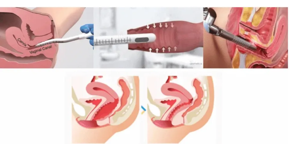Thẩm mỹ thu nhỏ cô bé phương pháp nào tốt nhất? Nên phẫu thuật hay không phẫu thuật? 4 Thu nhỏ cô bé bằng laser