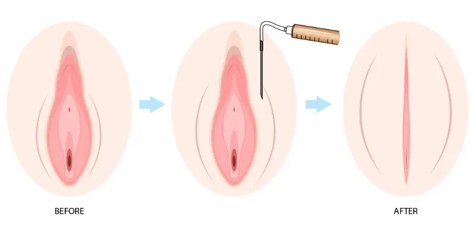 Tiêm filler làm đầy vùng kín có an toàn không? Ưu nhược điểm, đối tượng, bảng giá và phương án thay thế 2 Tiêm filler làm đầy vùng kín có an toàn không
