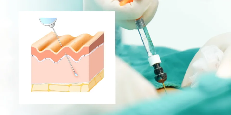 Tiêm filler làm đầy vùng kín có an toàn không? Ưu nhược điểm, đối tượng, bảng giá và phương án thay thế 4 Tiêm filler HA vùng kín có an toàn không