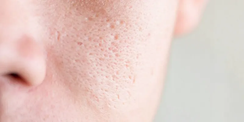 Tiêm meso se khít lỗ chân lông - Giải pháp cho làn da không tì vết hay chỉ là lời quảng cáo? 2 Tiêm meso thu nhỏ lỗ chân lông