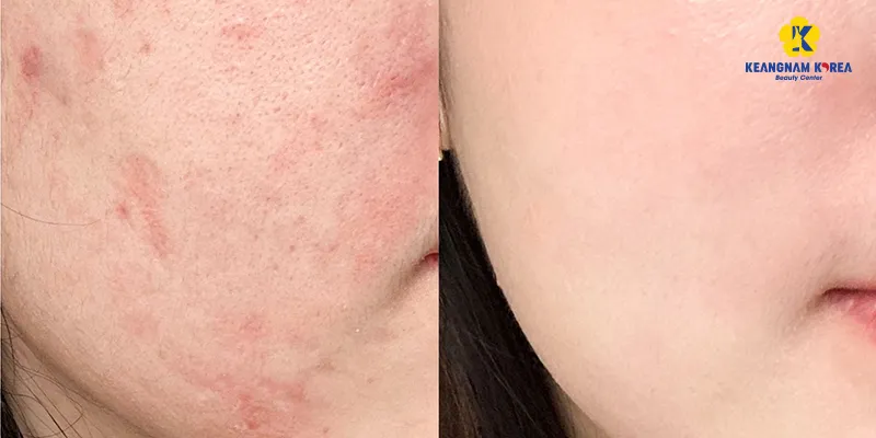 Tiêm meso se khít lỗ chân lông - Giải pháp cho làn da không tì vết hay chỉ là lời quảng cáo? 5 Tiêm meso thu nhỏ lỗ chân lông