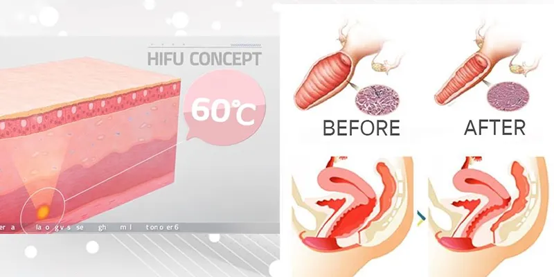 Trẻ Hóa Âm Đạo Cách Nào “Dịu Dàng” Hơn. Bảng Giá Và Ưu Nhược Điểm Các Phương Pháp Hiện Nay 3 Cách trẻ hóa vùng kín bằng laser
