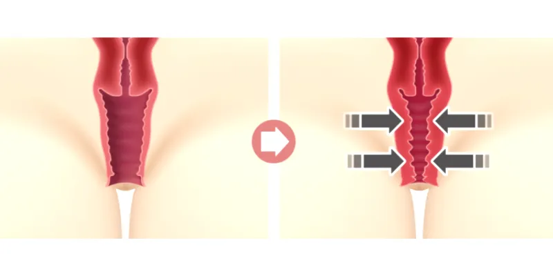 5 công nghệ trẻ hóa vùng kín không phẫu thuật an toàn, “nhẹ nhàng” với cô bé 3 tre hoa vung kin bang rf