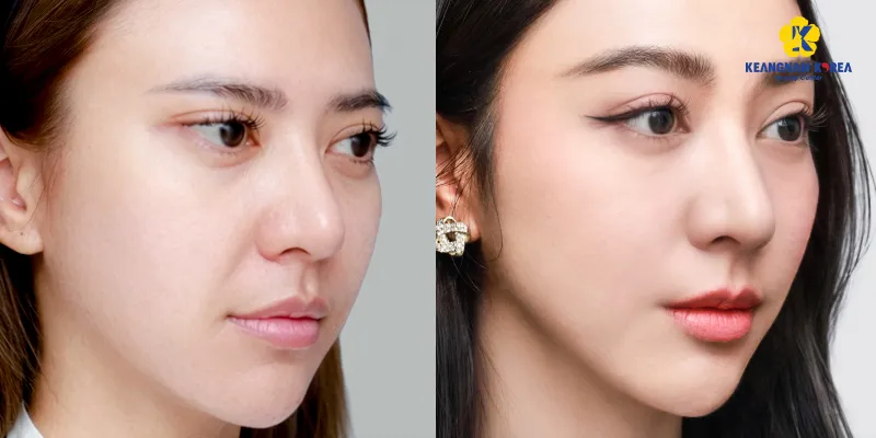 Hạ lệ mắt là gì? Giải pháp biến mắt xếch thành mắt to tròn, dịu dàng chuẩn Châu Á 2 Hạ lệ mắt là gì