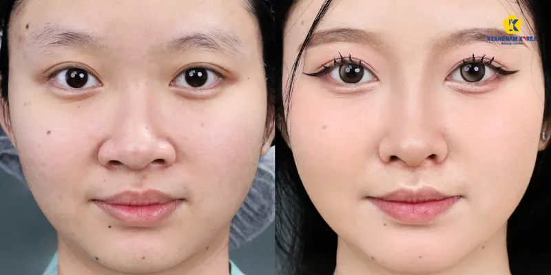 Con gái mũi to thì sao? Tướng số nhân tướng học và cách khắc phục 5 Con gái mũi to thì sao