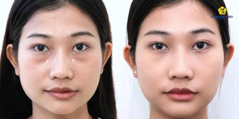 Bóc mỡ mí mắt là gì? So sánh bóc mỡ mí trên & dưới và bảng giá 2026 4 bf af boc mo mi duoi