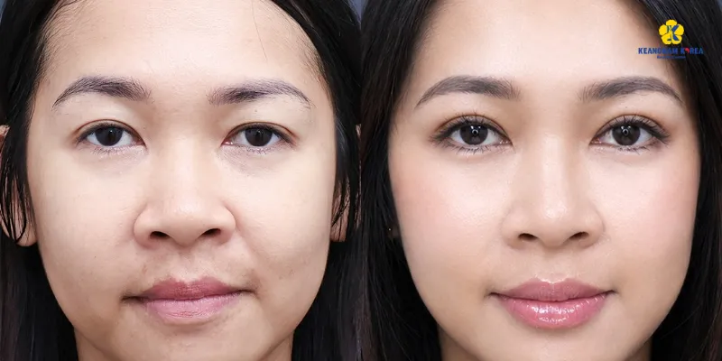 Bóc mỡ mí mắt là gì? So sánh bóc mỡ mí trên & dưới và bảng giá 2026 3 bf af boc mo mi tren