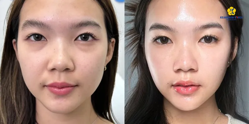 10 cách xóa quầng thâm mắt hiệu quả tại nhà & cơ sở thẩm mỹ 4 cách xóa quầng thâm mắt