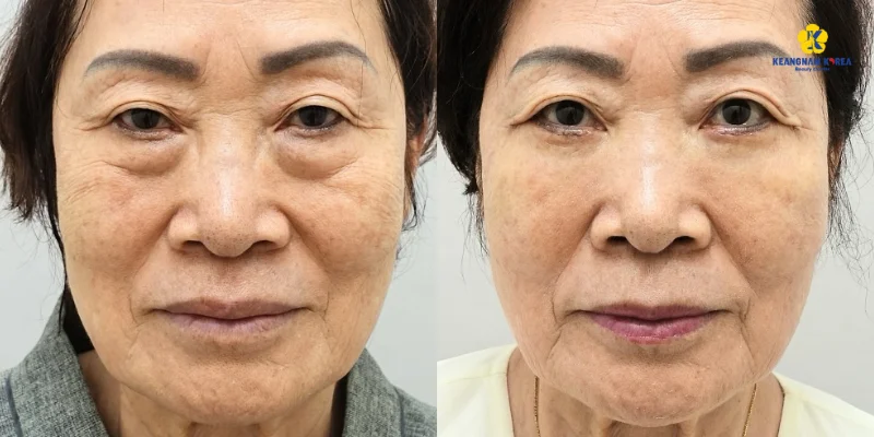 Bóc mỡ bọng mắt là gì? Quy trình thực hiện và bảng giá mới nhất 2026 6 boc mo bong mat 6