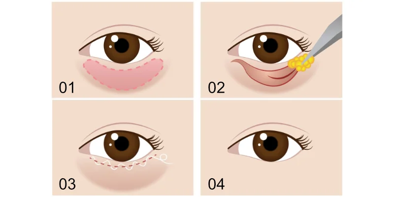 Bóc mỡ bọng mắt là gì? Quy trình thực hiện và bảng giá mới nhất 2026 1 Bóc mỡ bọng mắt là gì
