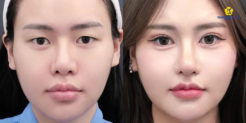 Bóc mỡ mắt nội soi là gì? Ưu nhược điểm và bảng giá 2026 2 bóc mỡ mắt nội soi