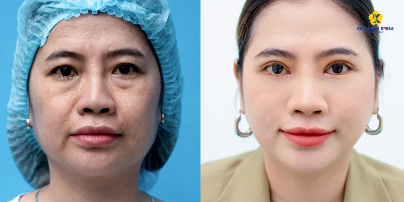 Bóc mỡ mắt nội soi là gì? Ưu nhược điểm và bảng giá 2026 5 bóc mỡ mắt nội soi