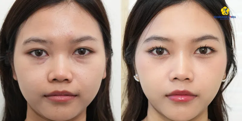 Bóc mỡ mí mắt dưới là gì? 4 phương pháp phổ biến và bảng giá 2026 5 bóc mỡ mí mắt dưới