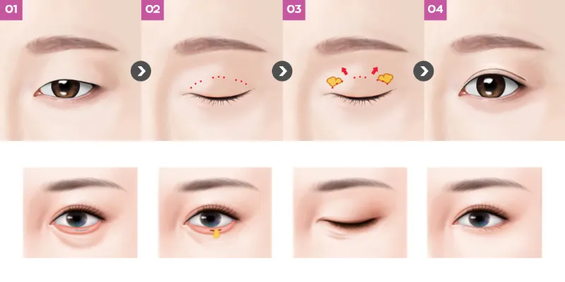 Bóc mỡ mí mắt là gì? So sánh bóc mỡ mí trên & dưới và bảng giá 2026 2 boc mo mi mat la gi 1