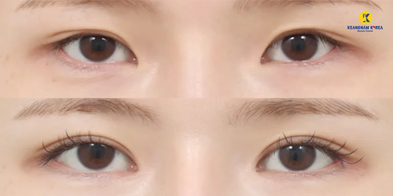 Bóc mỡ mí mắt trên là gì? Quy trình, giá và những điều cần biết 3 Bóc mỡ mí mắt trên