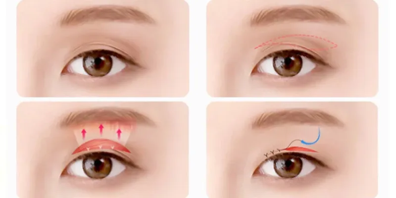 Bóc mỡ mí mắt trên là gì? Quy trình, giá và những điều cần biết 4 Bóc mỡ mí mắt trên