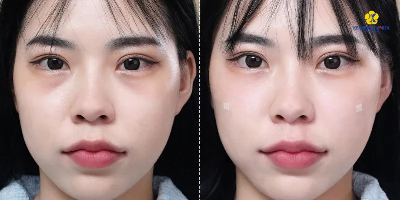 10 cách loại bỏ quầng thâm mắt nhanh nhất, hiệu quả tức thì 1 cách loại bỏ quầng thâm mắt nhanh nhất