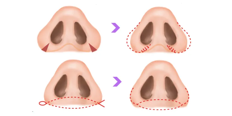 Có nên cắt cánh mũi không? 5 dấu hiệu cần can thiệp và những lưu ý cần biết để tránh "xôi hỏng bỏng không 2 Có nên cắt cánh mũi không