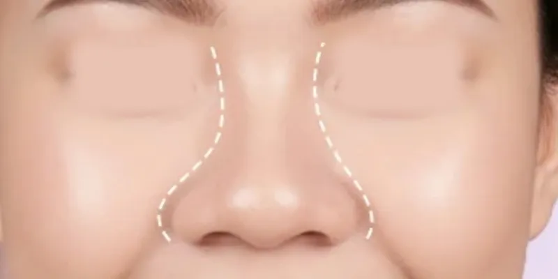 Có nên cắt cánh mũi không? 5 dấu hiệu cần can thiệp và những lưu ý cần biết để tránh "xôi hỏng bỏng không 3 Có nên cắt cánh mũi không