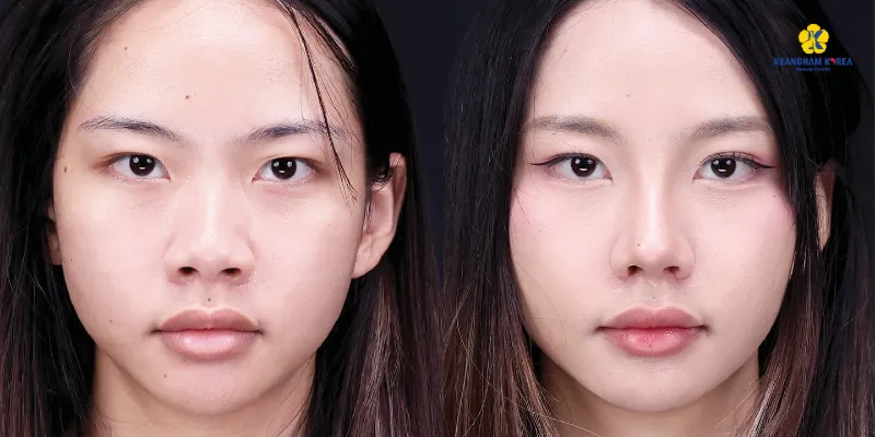 Có nên cắt cánh mũi không? 5 dấu hiệu cần can thiệp và những lưu ý cần biết để tránh "xôi hỏng bỏng không 5 Có nên cắt cánh mũi không