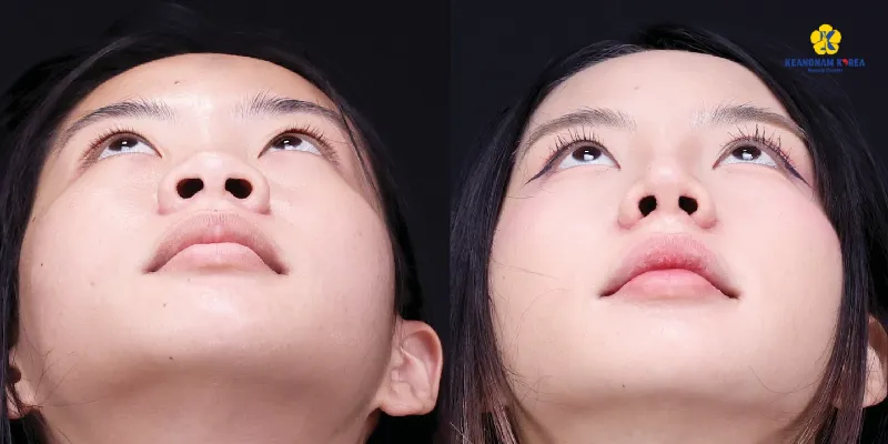 Có nên cắt cánh mũi không? 5 dấu hiệu cần can thiệp và những lưu ý cần biết để tránh "xôi hỏng bỏng không 6 Có nên cắt cánh mũi không
