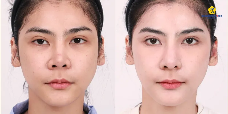 Cuộn cánh mũi bao lâu thì lành? Lịch trình hồi phục chi tiết theo ngày 3 cuộn cánh mũi bao lâu thì lành