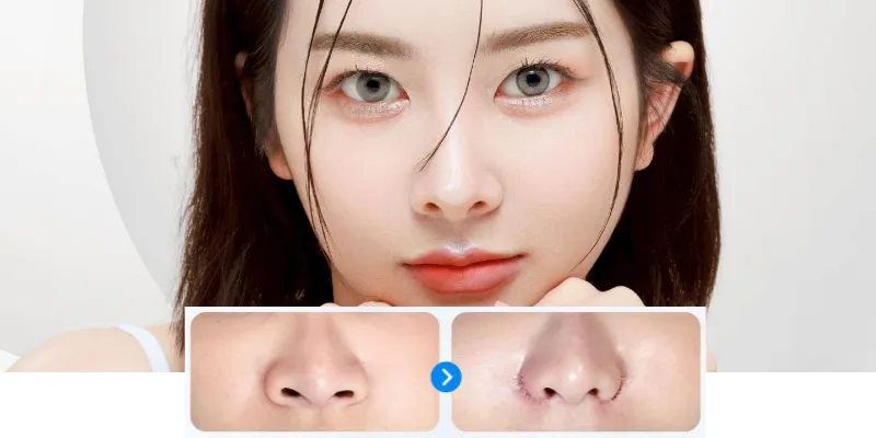 Cuộn cánh mũi có bị to lại không? 2 Cuộn cánh mũi có bị to lại không