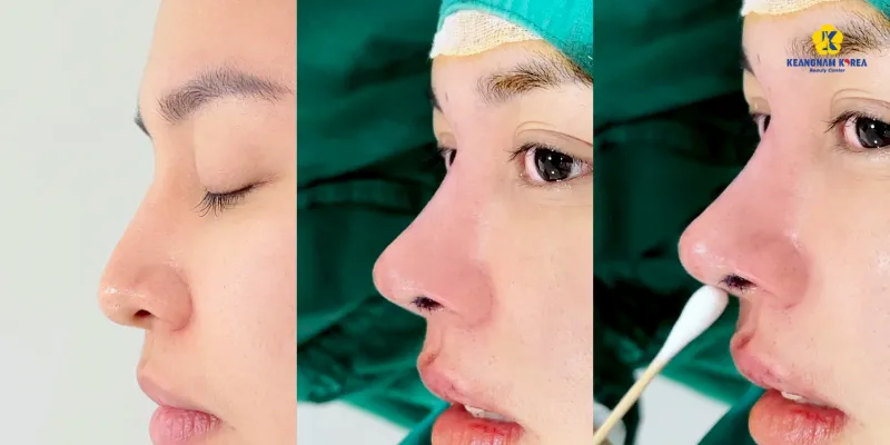 Cuộn cánh mũi có bị to lại không? 3 Cuộn cánh mũi có bị to lại không