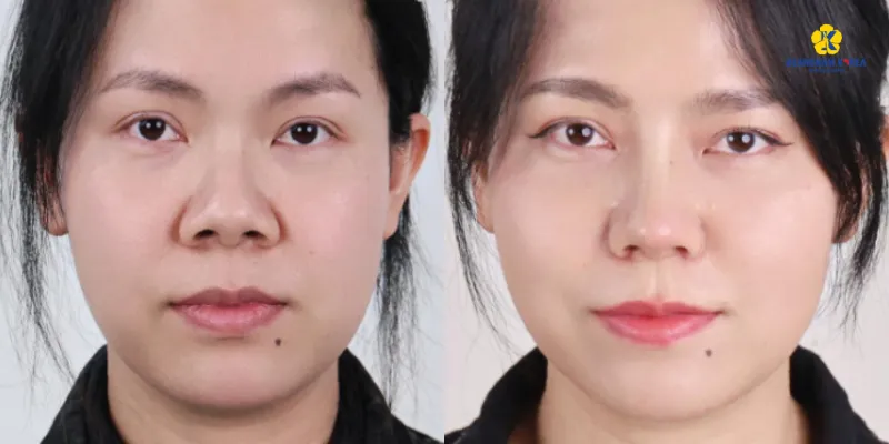 Cuộn cánh mũi có vĩnh viễn không? 4 Cuộn cánh mũi có vĩnh viễn không?