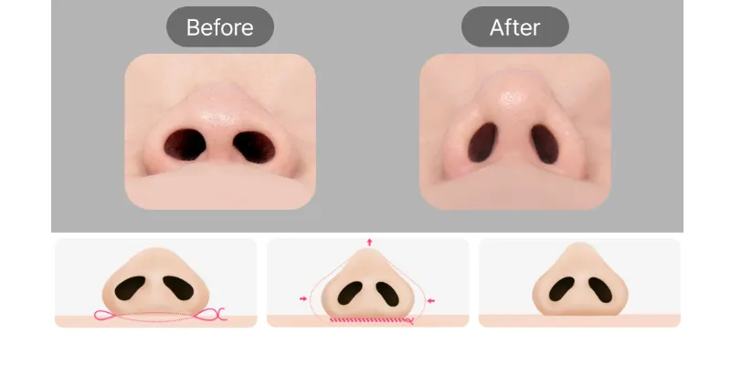Cuộn cánh mũi có vĩnh viễn không? 2 Cuộn cánh mũi có vĩnh viễn không?
