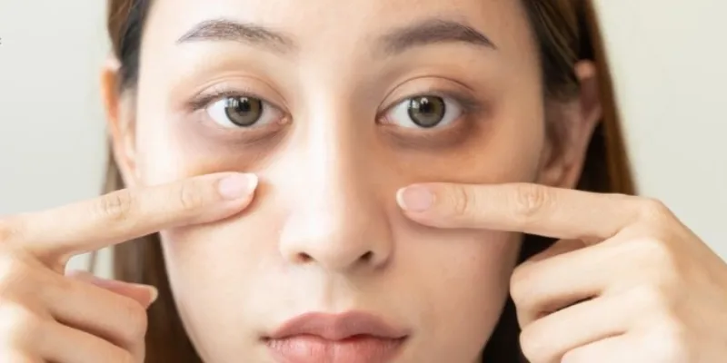 How Much Does Eye Bag Removal Cost Across Asia? 2 How Much Does Eye Bag Removal Cost Across Asia?