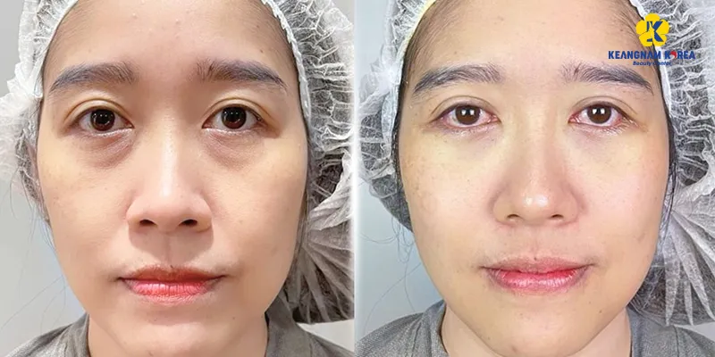 How Much Does Eye Bag Removal Cost Across Asia? 4 eye bag removal cost
