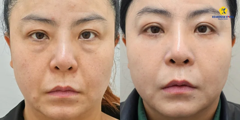 Bóc mỡ bọng mắt là gì? Quy trình thực hiện và bảng giá mới nhất 2026 7 hinh anh boc mo bong mat thuc te 7