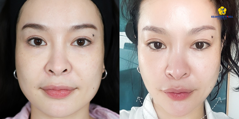 Liệu trình trẻ hóa da mặt giá bao nhiêu? Bảng giá 5 phương pháp 2026 3 liệu trình trẻ hóa da mặt giá bao nhiêu