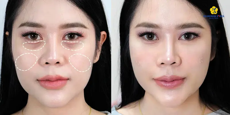 4 phương pháp phẫu thuật xóa quầng thâm mắt 2026 2 phẫu thuật xóa quầng thâm mắt