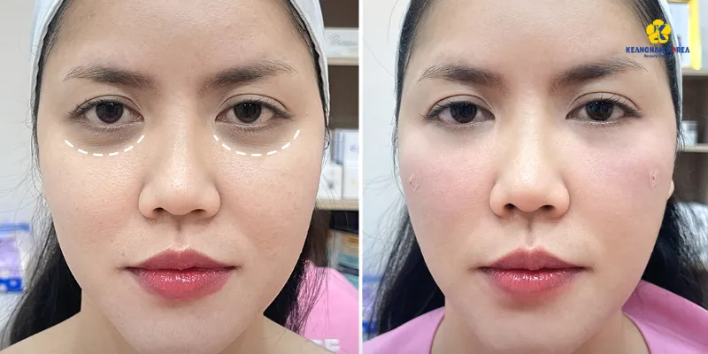 4 phương pháp phẫu thuật xóa quầng thâm mắt 2026 4 phẫu thuật xóa quầng thâm mắt