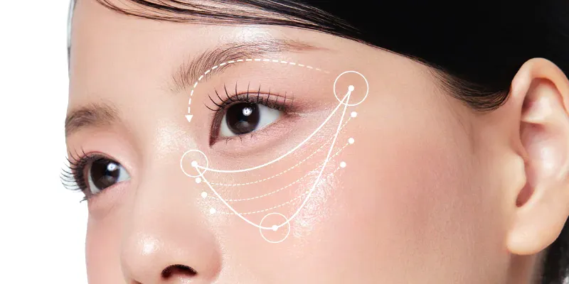 phẫu thuật xóa quầng thâm mắt