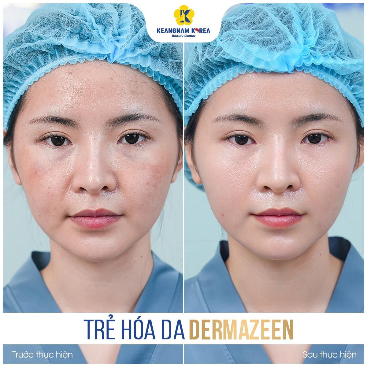 Trang chủ 55 BF-AF_Dermazeen1
